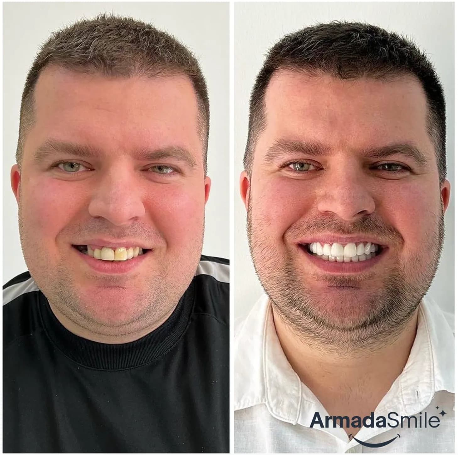Before & after dental transformation 1