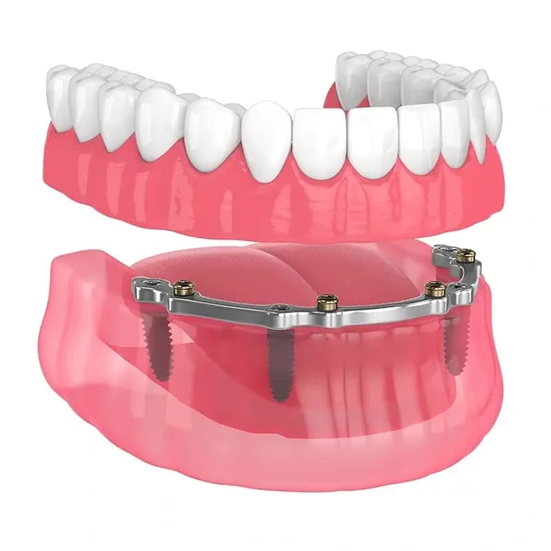 Laminate Veneers