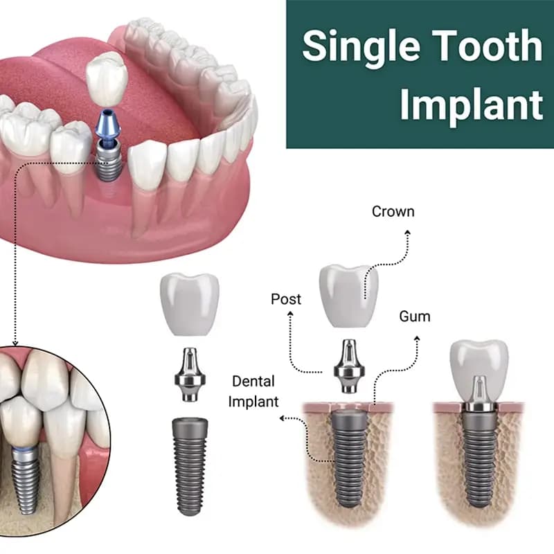 Single Dental Implant